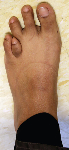 Health Insurance For Children >> Brachymetatarsia | International Center for Limb Lengthening Health Insurance For Children >> Brachymetatarsia | International Center for Limb Lengthening