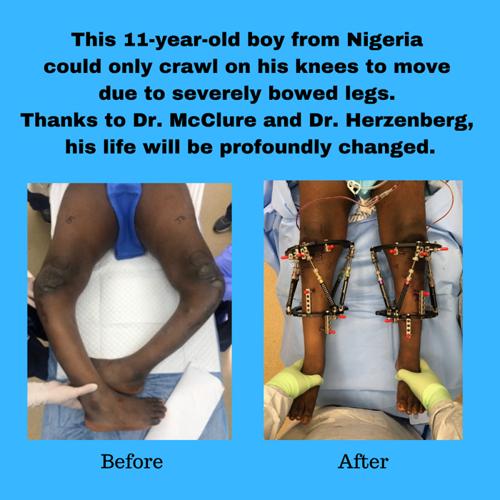 A before photo of a patient’s legs that are severely bowed and an after photo of his legs after an operation that straightened them and added external fixators to them