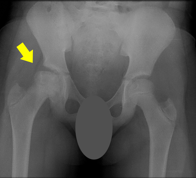 X-ray of an 11-year-old female with AVN of the right hip from sickle cell disease
