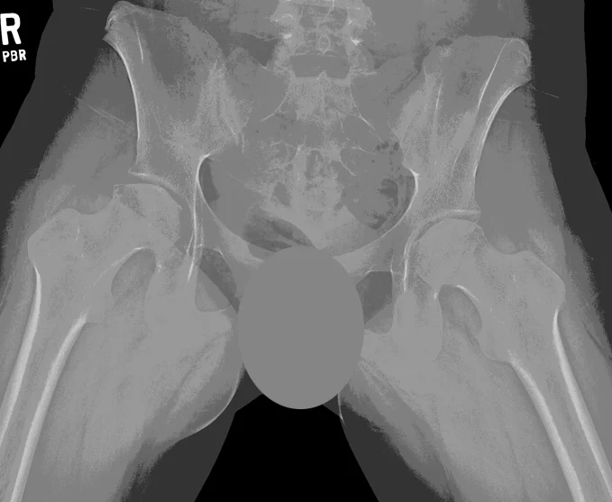 14-year-old female with bilateral hip AVN secondary to corticosteroid treatment for leukemia