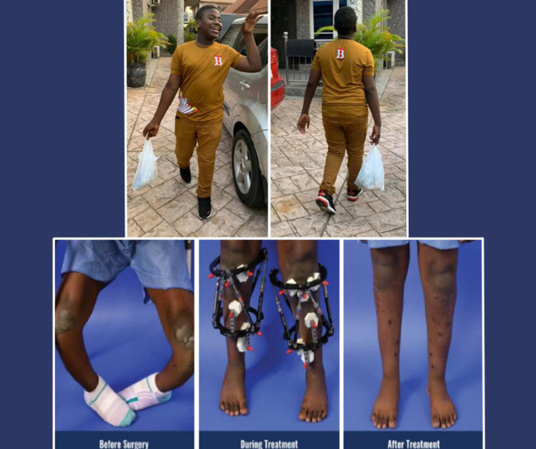 Collage showing Success smiling walking to and from school and three photos showing his severely bowed legs before surgery, his legs in external fixators during treatment, and his straight legs after treatment