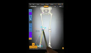 Screenshot of a video tutorial demonstrating how to use the Bone Ninja app for deformity correction