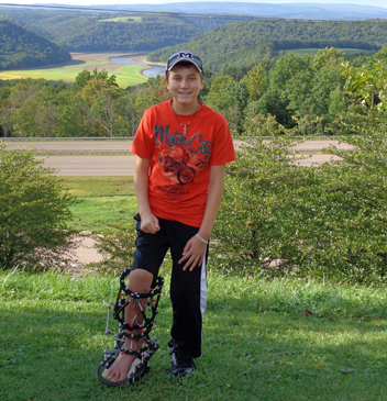 Chase out enjoying nature while wearing an external fixator