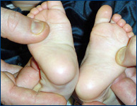 3-month-old baby with clubfoot after undergoing Ponseti casting and tenotomy at the International Center for Limb Lengthening