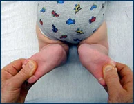 2-month-old baby with clubfoot after undergoing Ponseti casting and tenotomy at the International Center for Limb Lengthening, back view