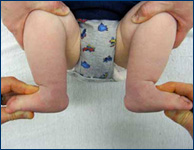 2-month-old baby with clubfoot after undergoing Ponseti casting and tenotomy at the International Center for Limb Lengthening, front view