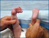 3-month-old baby with clubfoot before treatment back view