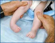 3-month-old baby with clubfoot before treatment front view