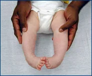 2-month-old baby with clubfoot before treatment