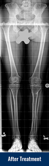 X-ray showing patient’s straight leg after treatment for Blount disease