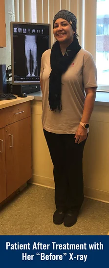 Smiling patient after treatment for Blount disease at the International Center for Limb Lengthening with straight legs posing by her bowed “before” X-ray