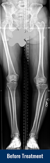 X-ray showing patient’s bowed leg from Blount disease before treatment