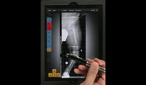 Screenshot of a video tutorial demonstrating how to use the Bone Ninja app for deformity correction