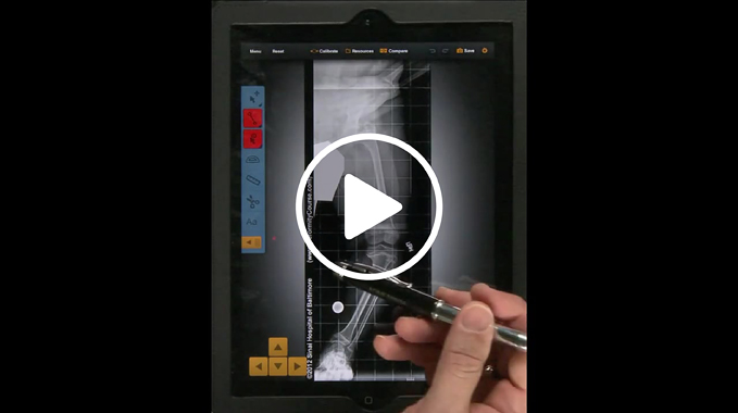 Screenshot of a video tutorial demonstrating how to use the Bone Ninja app for deformity correction