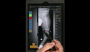 Screenshot of a video tutorial demonstrating how to use the Bone Ninja app for deformity correction