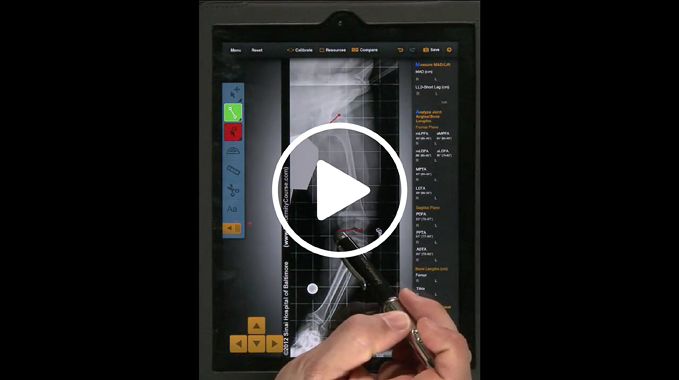 Screenshot of a video tutorial demonstrating how to use the Bone Ninja app for deformity correction