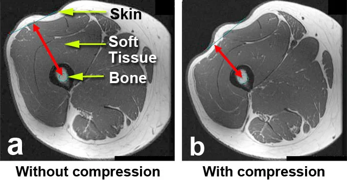 Two MRIs show how compressing the skin/tissue on the thigh helps the ERC get closer to the Precice
