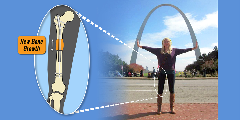 An International Center for Limb Lengthening patient after treatment with an illustration of an internal lengthening device