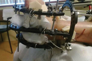 Jacob's ankle during treatment