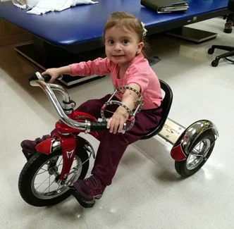 Anicka during treatment Wearing ex fix While on tricycle in physical therapy at the Rubin Institute