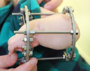 Ilizarov external fixator applied to the forearm