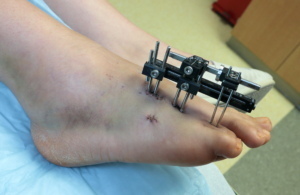 Monolateral external fixator applied to the foot