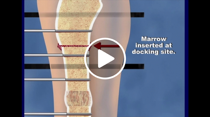 Illustration of how a bone infection is treated at the International Center for Limb Lengthening