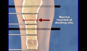 Illustration of how a bone infection is treated at the International Center for Limb Lengthening