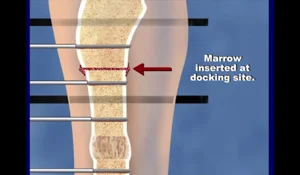 Illustration of how a bone infection is treated at the International Center for Limb Lengthening