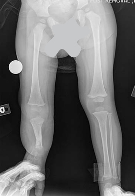 AP x-ray of the leg of a patient with fibular hemimelia, after a SUPERankle procedure was performed and the external fixator was removed, showing the deformities have been corrected