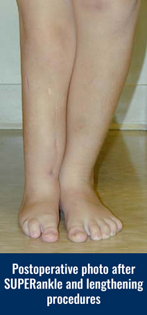 Postoperative photo of a patient's legs after SUPERankle and lengthening procedures for fibular hemimelia