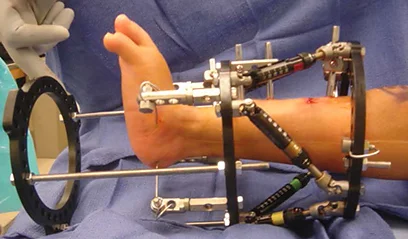 View from the side of a patient's leg with a Taylor Spatial Frame applied