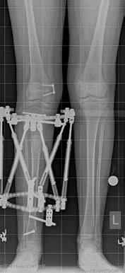 X-ray showing a patient's leg with an external fixator applied, after tibial lengthening treatment for fibular hemimelia