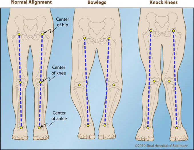 Three color illustrations showing alignment from the hip to the ankle in an AP view. Images show normal alignment, knock knee alignment and bow leg alignment.
