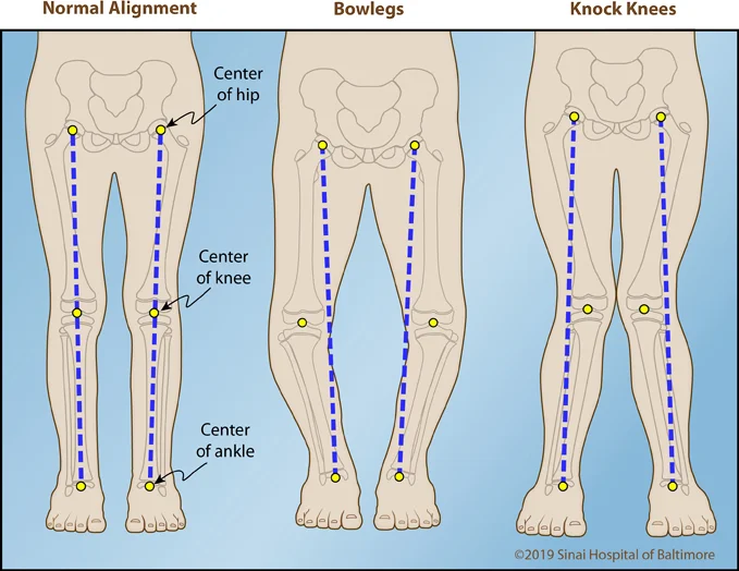 Bowlegs International Center For Limb Lengthening