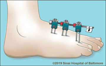 https://www.limblength.org/wp-content/uploads/2019/03/Art_External-Fixation-Brachymetatarsal-Correction.jpg