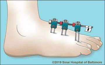 Monolateral external fixator applied to the foot