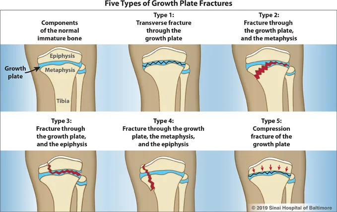Six color figures, each showing a tibia and fibula. The first image shows a normal immature bone and identifies the epiphysis, metaphysis, tibia and growth plate. It is followed by examples of each of the five types of growth plate fractures.
