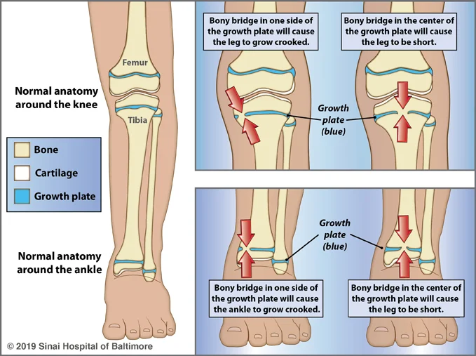 Three illustrations showing the effects of damage to a portion of a growth plate. Panel 1: Normal anatomy around the knee and ankle are shown with a key to the types of bone growth: bone, cartilage and growth plate. Panel 2: Illustrations of the knee showing that damage to the side of the growth plate will cause a bony bridge to form, and the leg will grow crooked. It also shows that damage to the center of the growth plate will cause a bony bridge to form and the leg will be short. Panel 3: Illustrations of the ankle showing that damage to the side of the growth plate will cause a bony bridge to form, and the ankle will grow crooked. It also shows that damage to the center of the growth plate will cause a bony bridge to form, and the leg will be short.