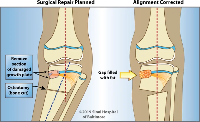 Two illustrations showing first, the malalignment of the knee, and the plan to remove a section of damaged growth plate and following osteotomy (bone cut). Second, bone realigned and growth plate gap filled with fat.
