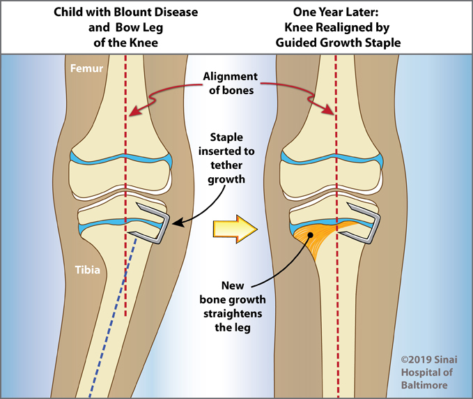 A staple is used to perform guided growth to correct a deformity in the tibia