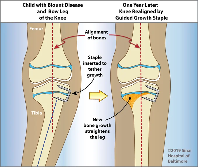 Internal Fixation Bone Staples International Center for Limb Lengthening