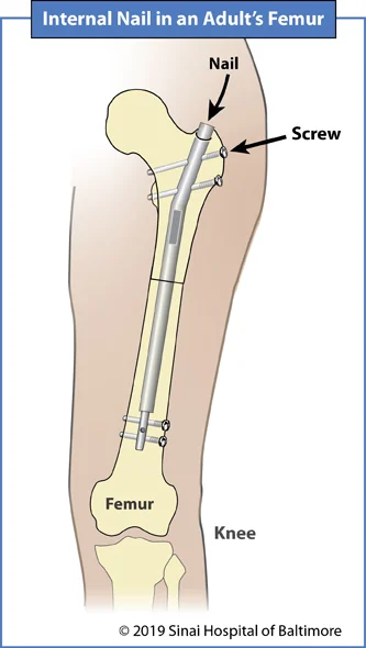 Precice nail in an adult's femur