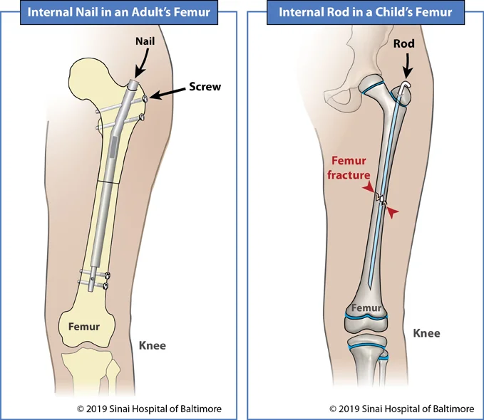 Internal nail in an adult's femur and internal rod in a child's femur