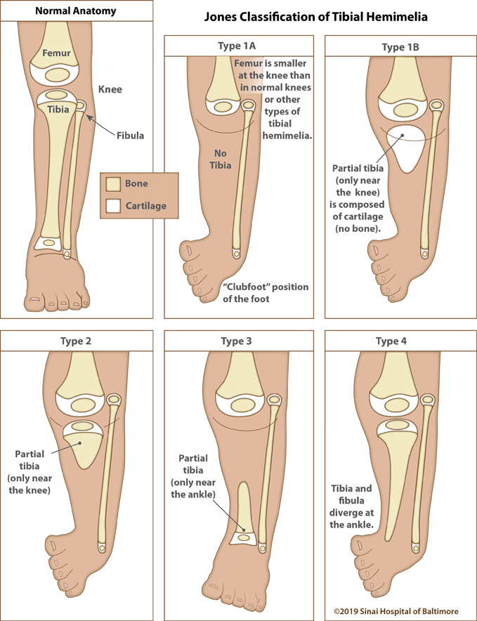 A CASE OF UNILATERAL TIBIAL HEMIMELIA WITH UNILATERAL RADIAL CLUB