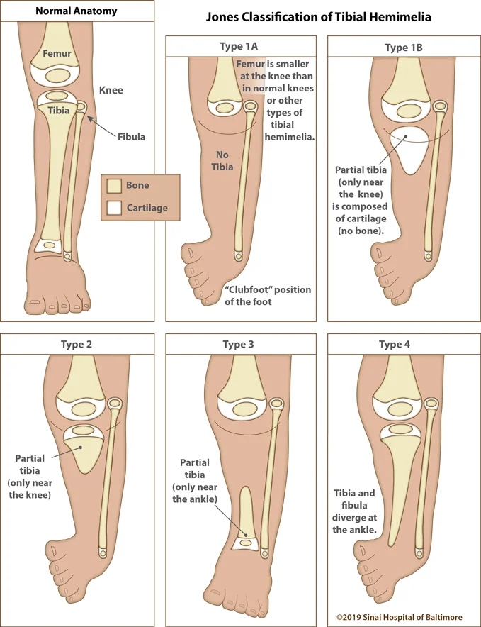 Six color illustrations. The first image shows a normal immature leg from above the knee to the toes and identifies the femur, tibia, fibula and knee. A key identifies the difference between bone and cartilage. Following illustrations depict the five classifications of tibial hemimelia to include: Type 1A, where the femur is smaller at the knee than in normal knees and other types of tibial hemimelias. There is no tibia present and the foot is in a clubfoot position. Type 1B where there is a partial tibia only near the knee and composed of only cartilage. The foot is in a clubfoot position. Type 2 where there is a partial tibia present only near the knee. The foot is in a clubfoot position. Type 3 where there is a partial tibia only near the ankle. Type 4 where the tibia and fibula diverge at the ankle. The foot is in a clubfoot position.