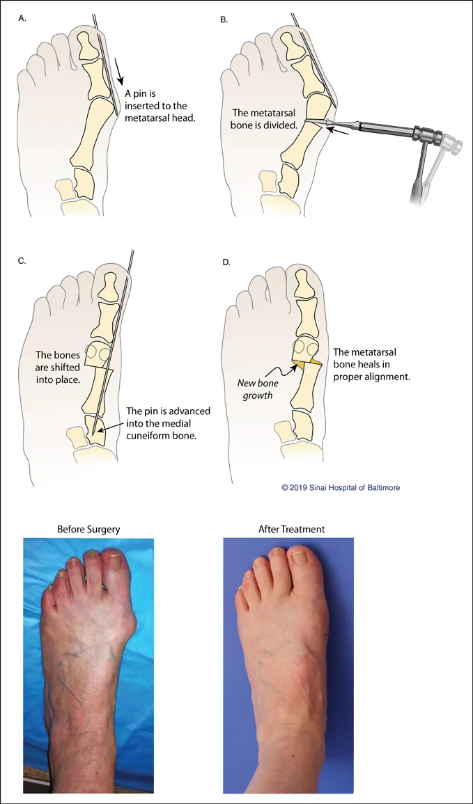 Four illustrations demonstrating the steps taken during minimally invasive bunion surgery and a before surgery picture of a patient's foot with a bunion and a picture of a foot after treatment at the International Center for Limb Lengthening which shows the bunion has been corrected