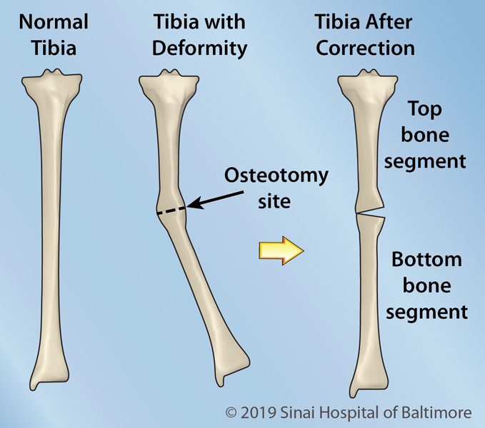 Three color figures, AP of the tibia. Image 1: Normal tibia; Image 2: Tibia with a mid-diaphyseal valgus deformity. Osteotomy site identified. Image 3: Alignment corrected with opening wedge osteotomy. Top and bottom bone segment identified.