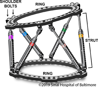 Labeled illustration of the Taylor Spatial Frame (TSF) that identifies the major components