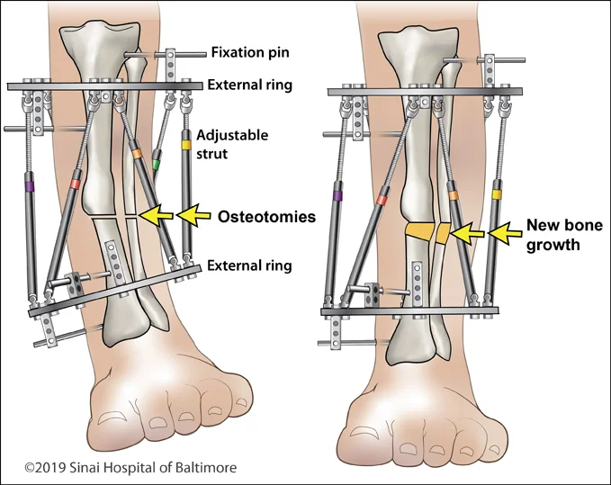 Two color figures showing a tibia with a mid-diaphyseal deformity with a Taylor Spatial Frame applied to correct the deformity. Hardware parts and new bone growth are identified.